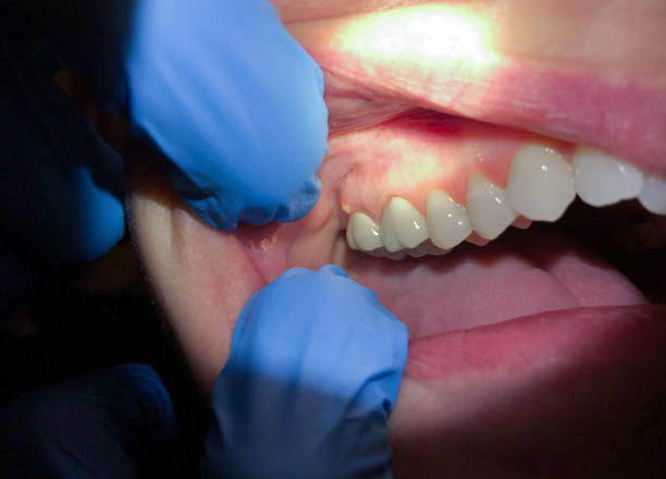 Best Emergency Root Canal Treatment in Campbellsport, WI