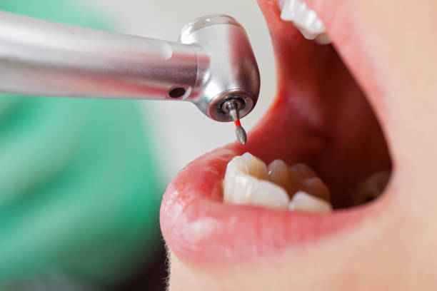 Best Emergency Dental Care for Broken or Chipped Teeth in Campbellsport, WI